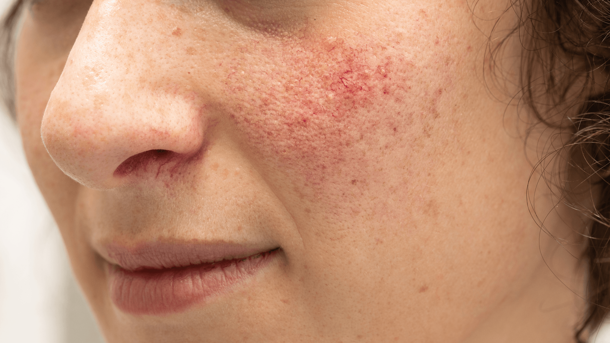 Types of Rosacea: Erythematotelangiectatic Rosacea - Gladskin