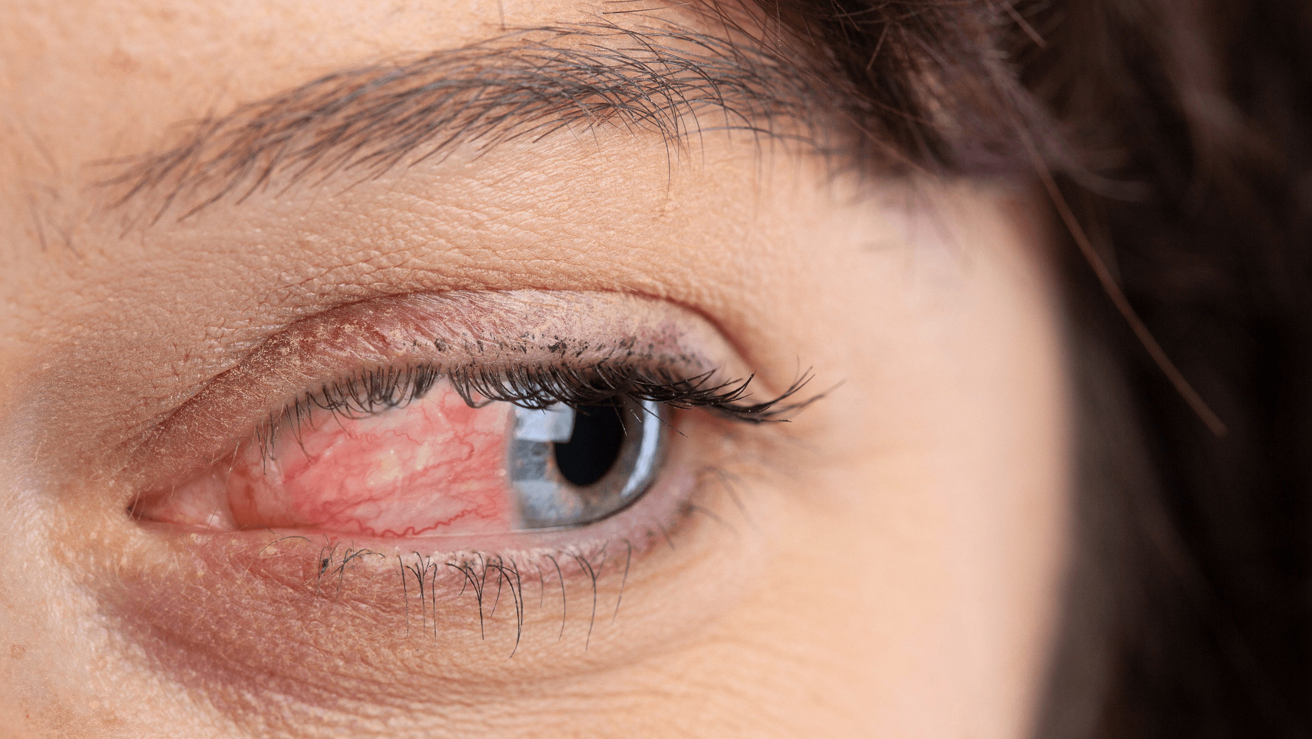 Types of Rosacea: Ocular Rosacea - Gladskin