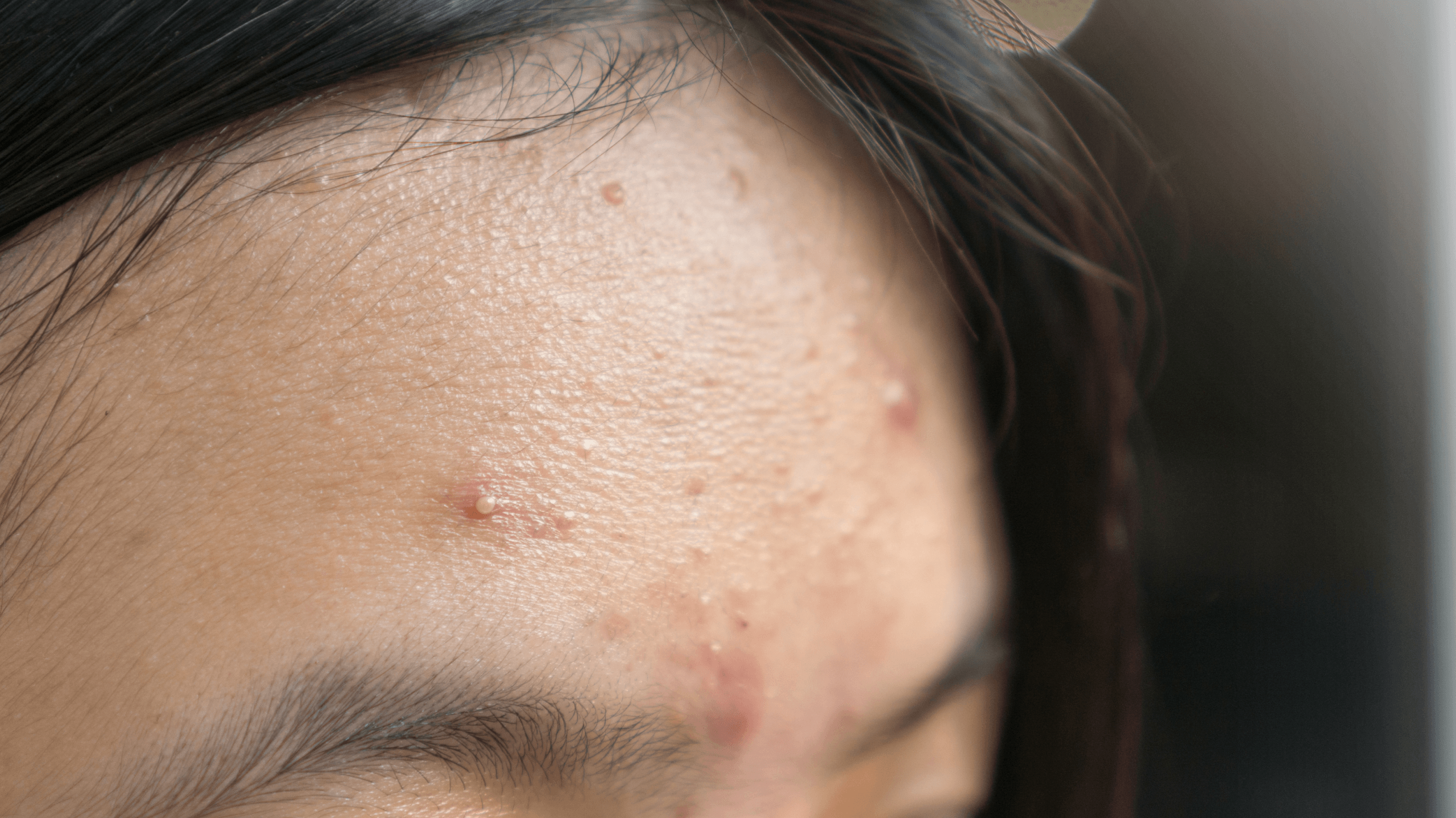 Face Mapping: Understanding Why You Break Out on Certain Areas of Your Face - Gladskin