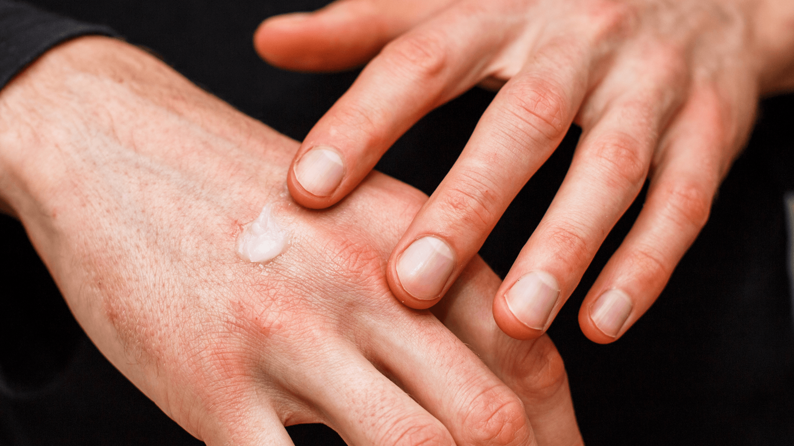 Combating Skin Inflammation With Topical Steroids - Gladskin