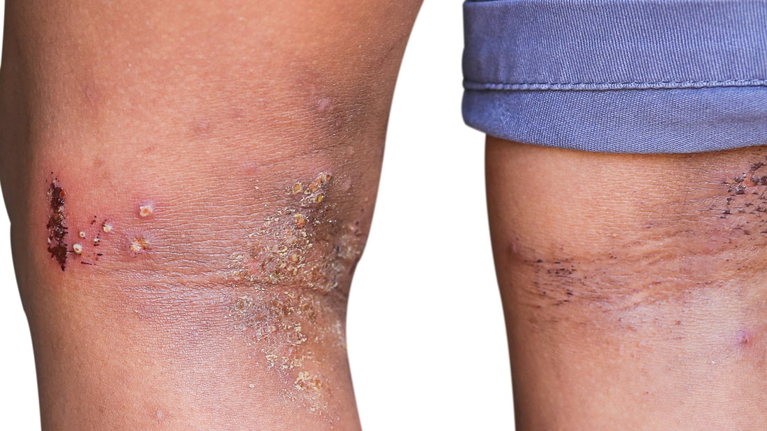 Is Eczema Contagious? - Gladskin