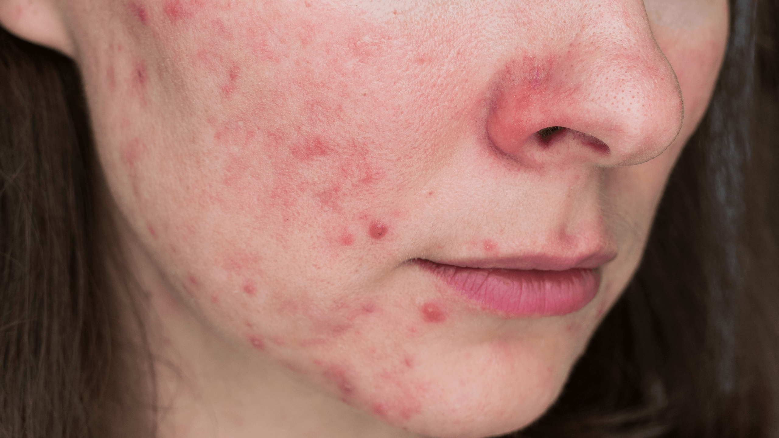 Types of Rosacea: Papulopustular Rosacea - Gladskin