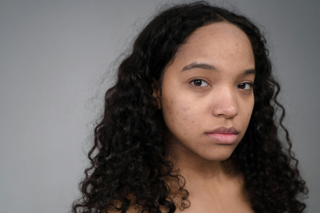 Rosacea vs. Acne
