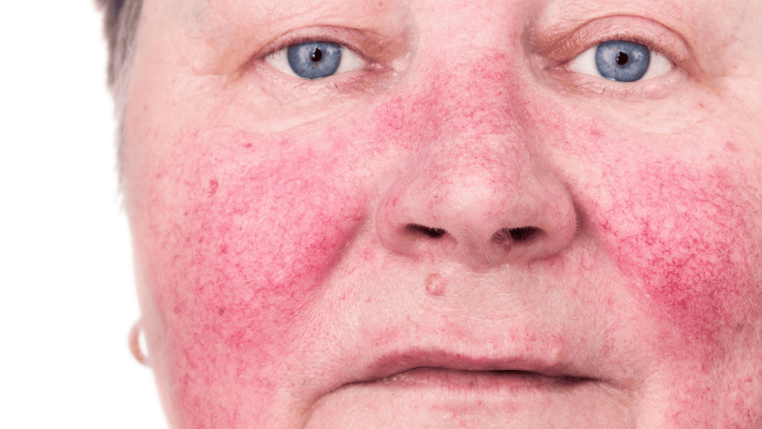 Types of Rosacea: Phymatous Rosacea - Gladskin
