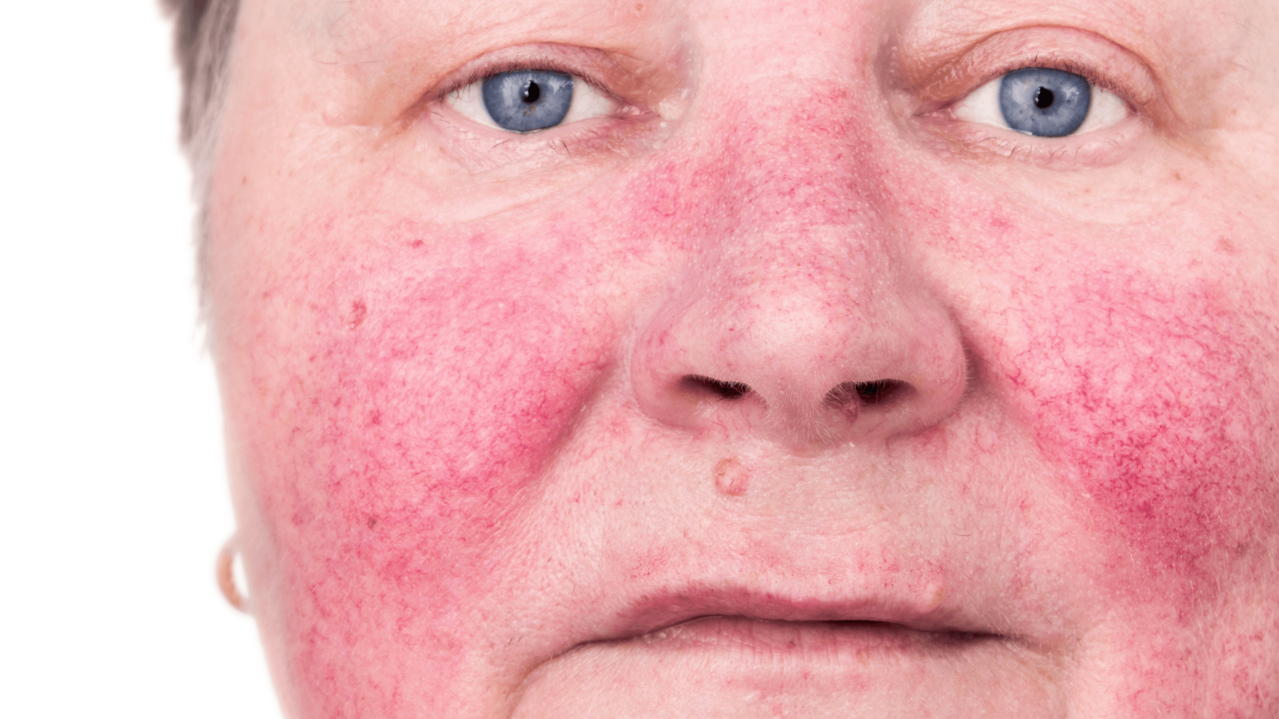 Types of Rosacea: Phymatous Rosacea - Gladskin