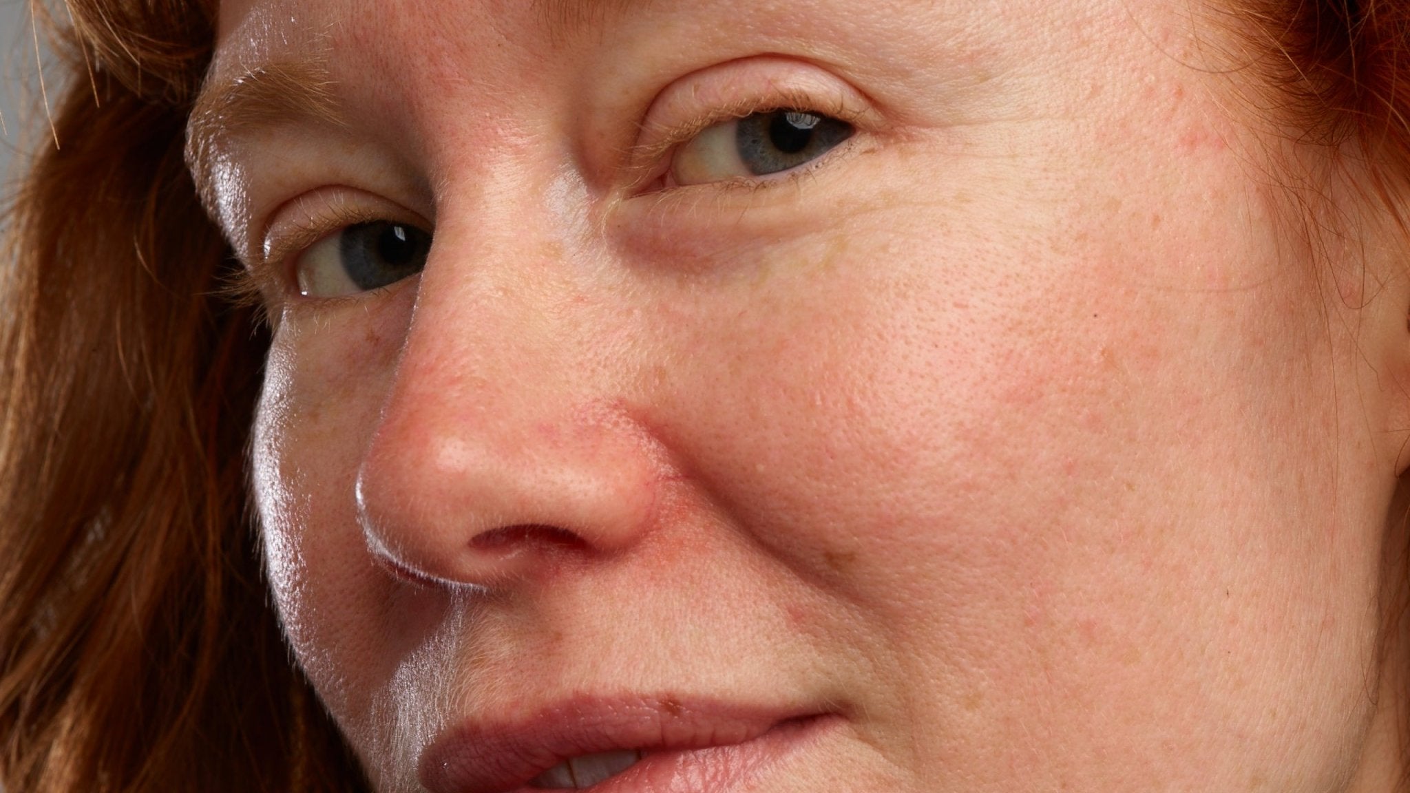 Rosacea + Eye Health: What’s the Connection? - Gladskin