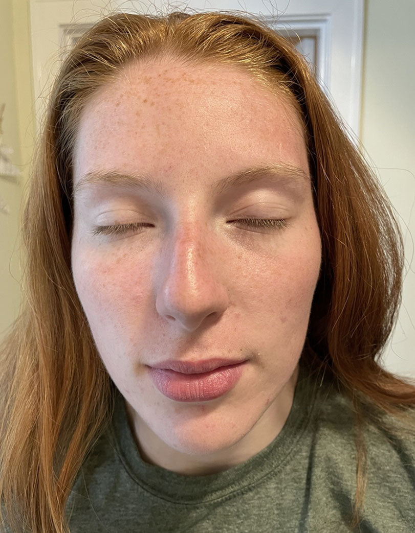 SteroidFree Eczema Treatment Eczema Collection Gladskin